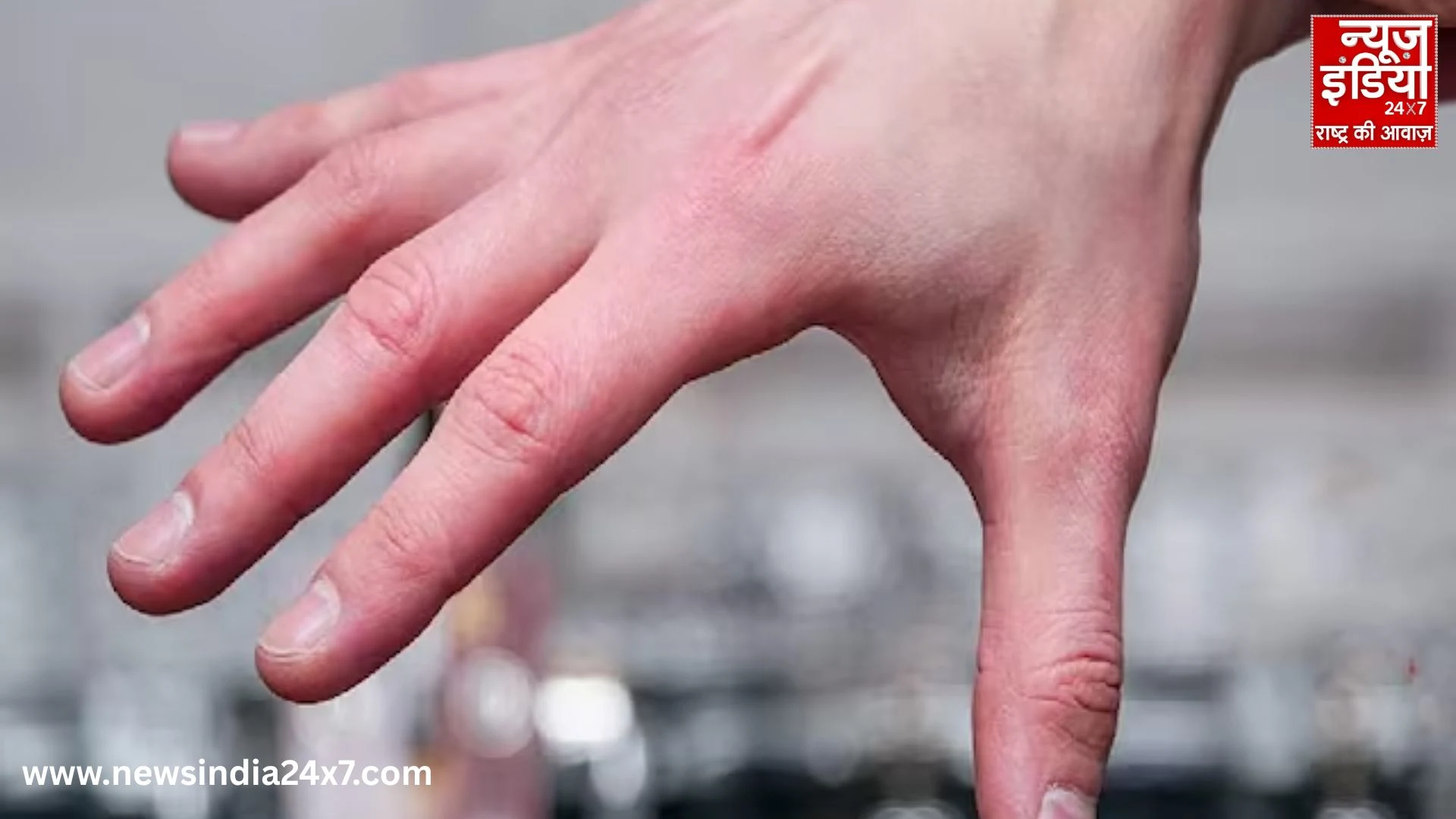 Winter Swollen Fingertip