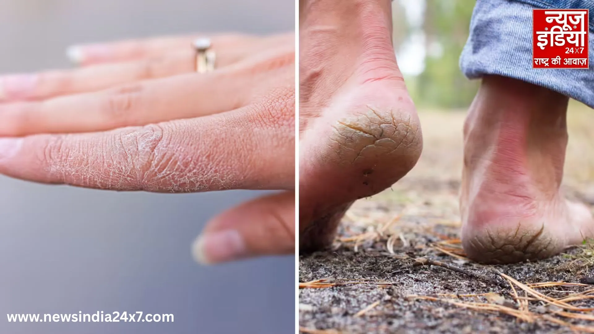 Natural magic for dry and cracked skin on hands and feet in winter; learn how to make it.